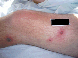 Pustular lesions with central necrosis on the left leg of a patient with Sweet's syndrome associated with Crohn's disease