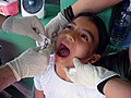 US Navy 090331-N-1580K-379 Dentist Cmdr. David Reiter and Hospital Corpsman 2nd Class Amy Brown prepared to remove a molar from 11-year old Isabel during the Beyond the Horizon humanitarian exercise in Honduras.jpg
