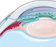 Visual system - Open-angle glaucoma -- Smart-Servier.png