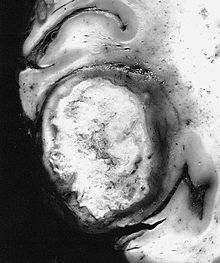 This figure illustrates how glioblastoma affects brain tissue. AFIP-00405562-GiantCellGlioblastoma-Gross.jpg