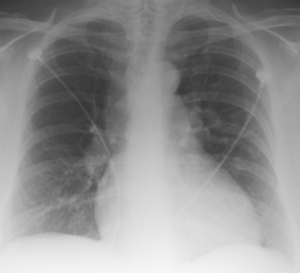 AP Chest X-Ray.tif