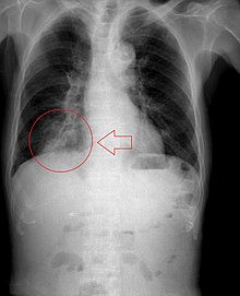X-ray of focal pneumonia in lower right lung lobe (bottom left of chest in image) due to aspiration and airway obstruction. Aspiration pneumonia201711-3264.jpg