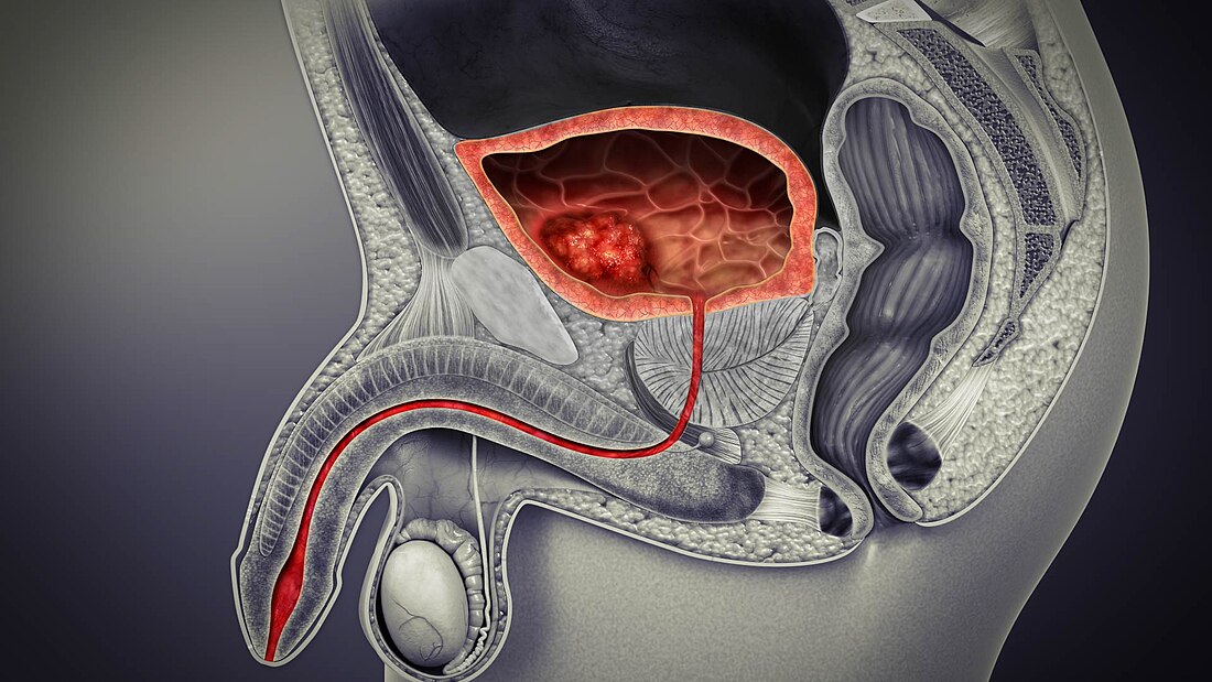 Underactive bladder