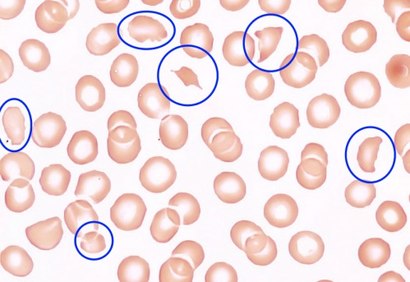 Blood smear with typical schistocytes in TTP marked in blue 1.tif