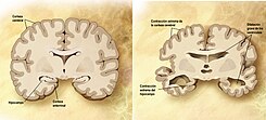 Cerebro normal vs alzheimer