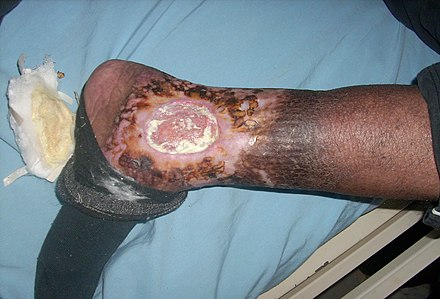 Chronic venous insufficiency & Venous ulcer