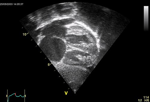 Ultrasound picture of the heart, seen in a subcostal view: The apex is towards the right, the atria are to the left. ASD secundum seen as a discontinuation of the white band of the atrial septum. The enlarged right atrium is below. The enlarged pulmonary veins are seen entering the left atrium above.