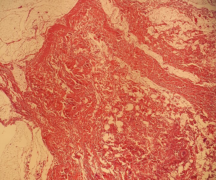 File:Histopathology of a fibrolipoma.jpg