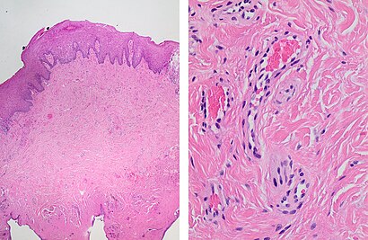 Histopathology of irritation fibroma.jpg