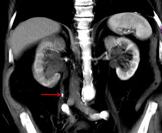 Nierensteine oder Nephrolithen