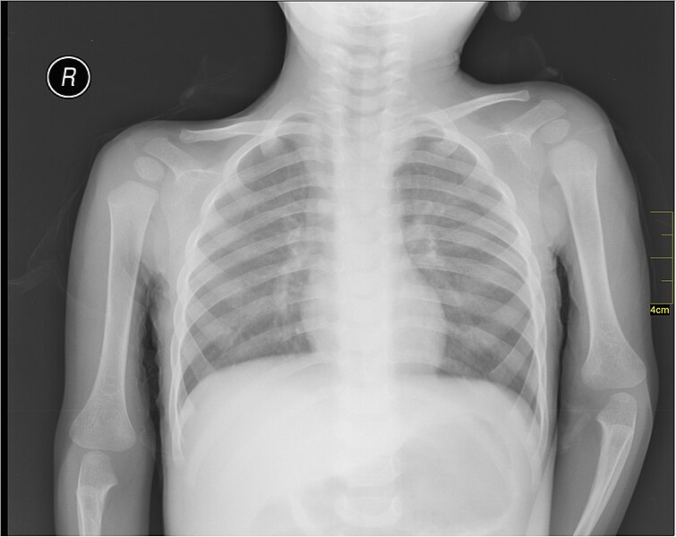 File:Medical X-Ray imaging WKU07 nevit.jpg