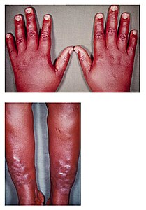 Myxedema.jpg