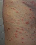 Vorschaubild für Pityriasis lichenoides et varioliformis acuta