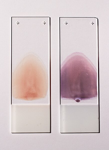 Archivo:Peripheral blood smear - stained and unstained.jpg