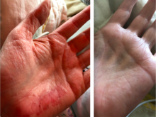 Steroid Atrophy Hands.png