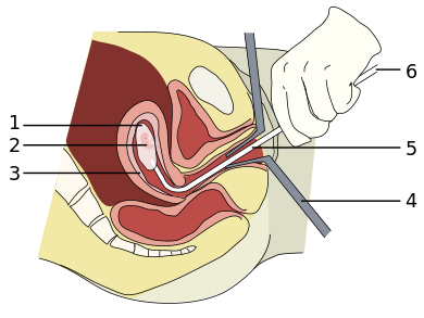 Diagram depicting a surgical abortion