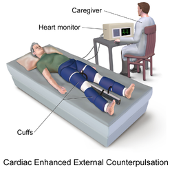 Enhanced external counterpulsation.