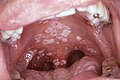 Oral candidiasis (soor)