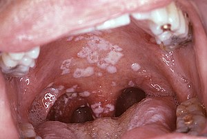 Candidiasis