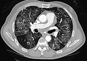 CT image showing crazy paving pattern of ground-glass opacities in both lungs.