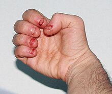 Dermatophagia - extreme nail biting / biting of skin to point of an obsessive compulsive disorder (OCD) or other condition leading to self mutilating behaviour such as autistic spectrum disorders (as is the case in this example) or Lesch-Nyhan Syndrome. Dermatophagia.jpg