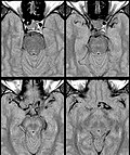 Thumbnail for Intracranial dolichoectasias