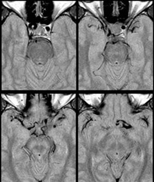 Dolichoectasia of the left internal carotid artery patientcase image2.jpg