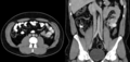 Doppelte Vena cava inferior27jm - CT axial und coronar - 001.png