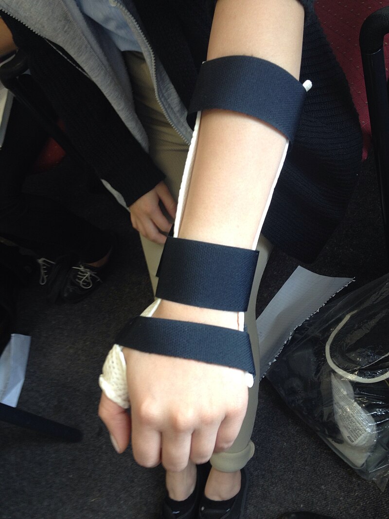 Upper Limb Orthotics/Bennett Fracture with Subluxation - Wikiversity