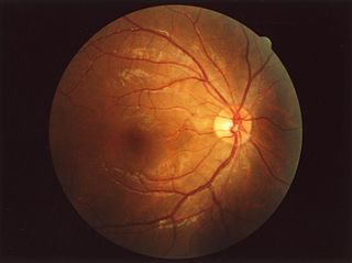 Fundus (eye)