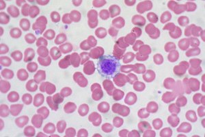 Giant Platelet, Peripheral Blood Smear (6032662354).jpg