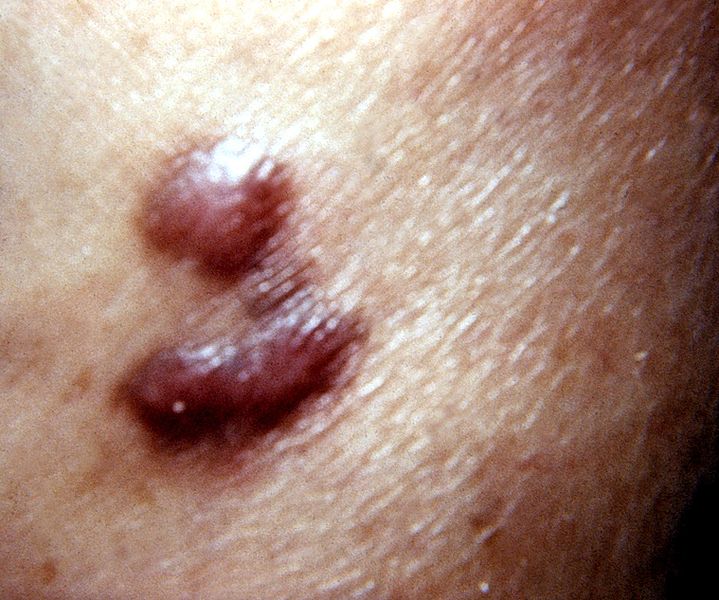 File:Kaposi's sarcoma lesion.jpg