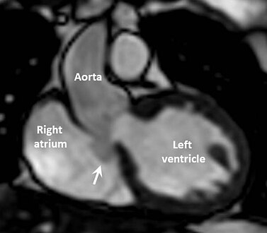 Cardiac MRI scan showing intact sinus of Valsalva aneurysm (arrowed) extending from non-coronary cusp to right atrium.