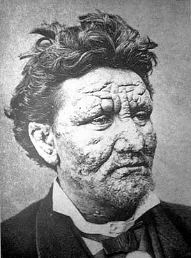 El rostro de un paciente de 24 años con lepra.  1886