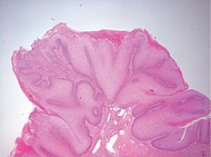 Micrograph of penile verrucous carcinoma - 20x.jpg