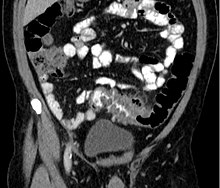 Diverticulitis on CT scan in coronal view