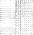 spike waves in a child with epilepsy