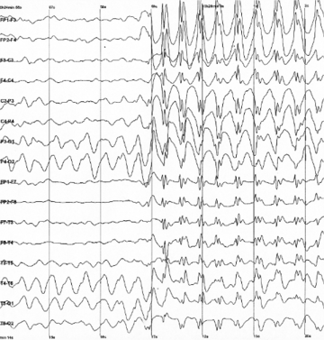 Electroencephalography