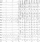 EEG d'une épilepsie