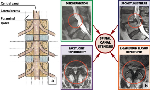 3 types of spinal stenosis on mri