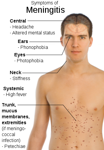 File:Symptoms of Meningitis.svg