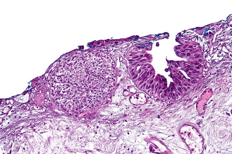 File:Urothelial carcinoma in situ (denuding), high mag.jpg