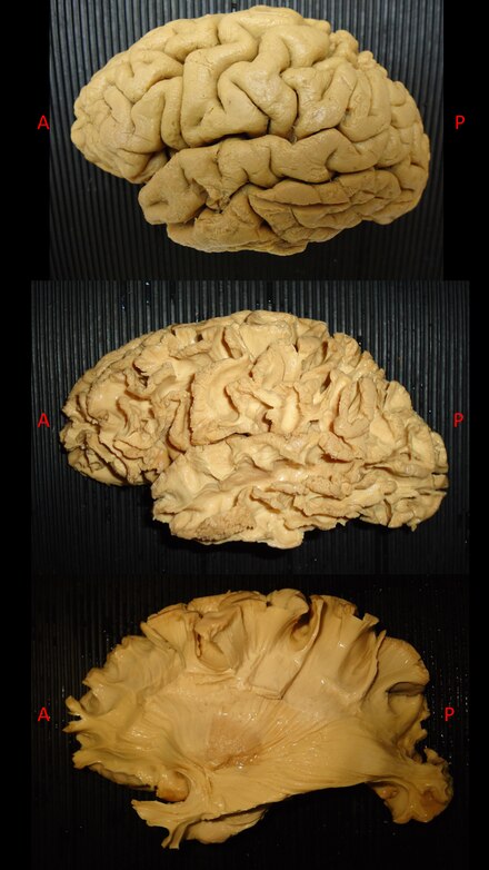 The picture shows three exemplary steps during white matter dissection. In the upper part, a left hemisphere has been prepared according to Klingler's technique. The arachnoidal layer and the blood vessels were previously removed. In the middle part of the picture the first step of white matter dissection with the exposure of short fibres (U-fibres) which are visible underneath the cerebral cortex. In the lower part, a deeper layer of anatomical dissection with white matter structures (associative and projection fibres) and basal ganglia (Putamen). White matter dissection.tif