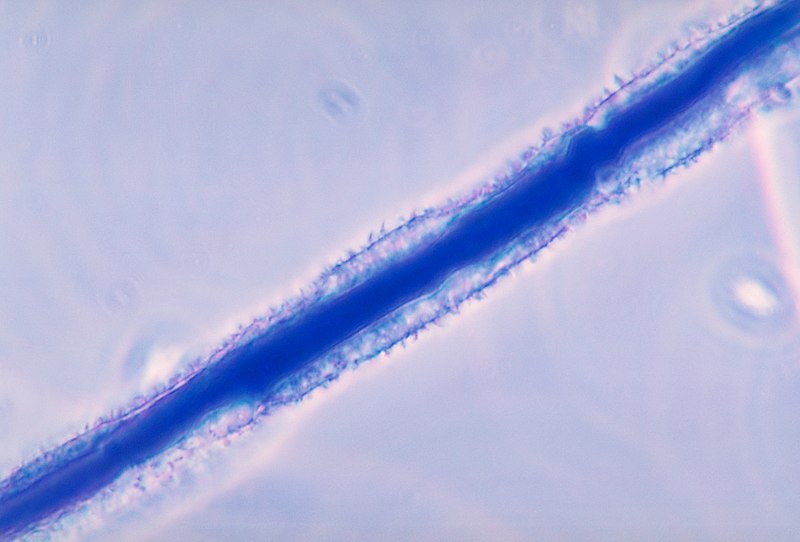 Onicomicosis en paciente inmunocompetente por Aspergillus sección Candidi