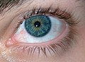 blaues Auge mit sowohl zentraler Iris-Heterochromie als auch sektorieller Iris-Heterochromie