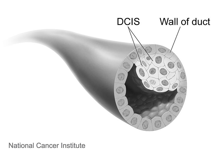 File:Breast cancer ductal carcinoma in situ.jpg