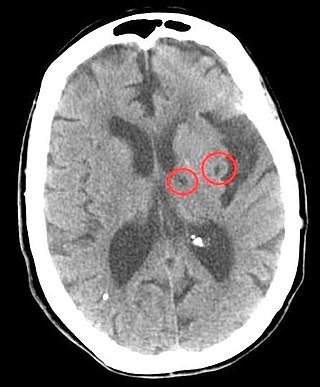 Brain cognitive function stroke