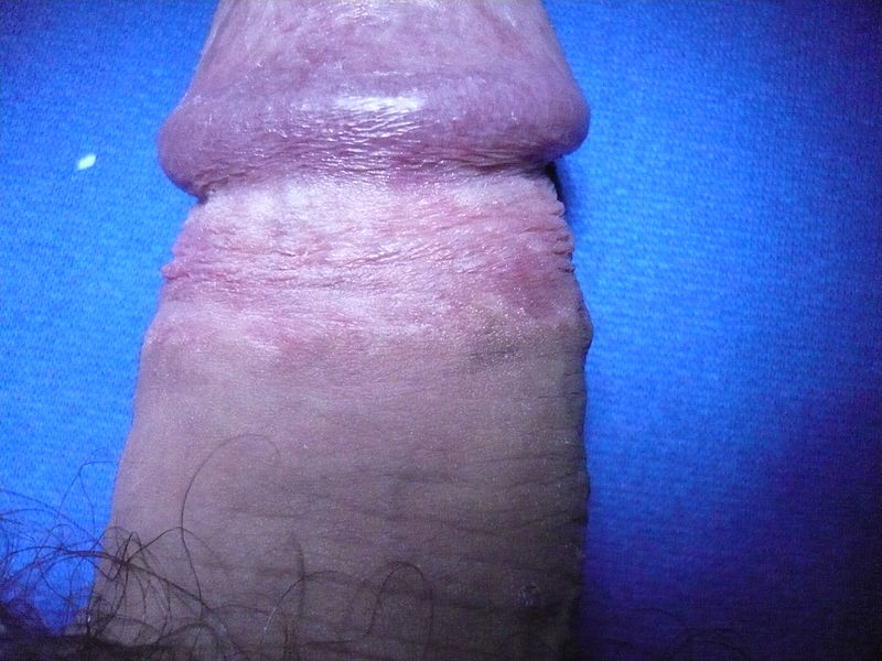 File:Circumcision scar.JPG