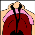 ปากแหว่งเพดานโหว่สองข้างสมบูรณ์ (Bilateral complete lip and palate)