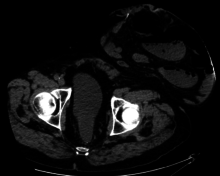 CT scan of same patient, showing intestines within the hernia. Colostomy and parastomal hernia - CT.png